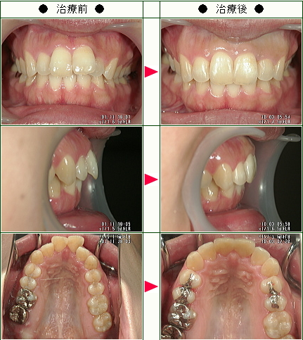 歯のデコボコ矯正症例(Ｉ．Ａ様　２９歳　女性)
