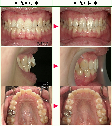 歯のデコボコ矯正症例(Ｉ.Ｆ様　２７歳　女性)