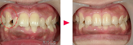 例１ 八重歯が治らない