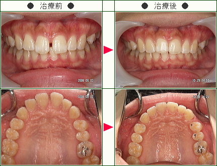 前歯のすきっ歯矯正症例(五十嵐様　２１歳　女性)