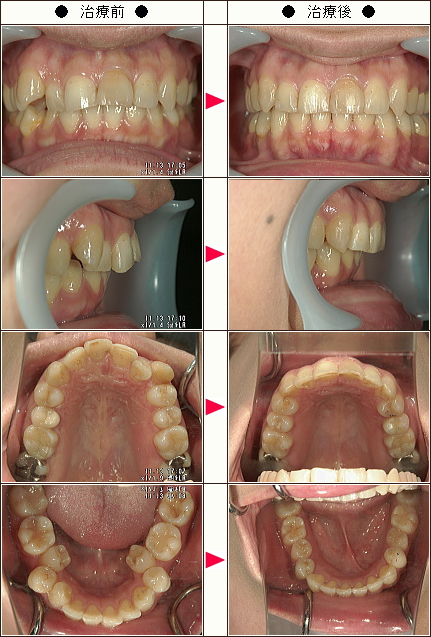 歯のデコボコ矯正症例［Ｉ・Ｋ様　３５歳　女性］