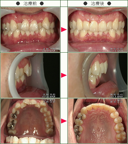 歯のデコボコ矯正症例(池田様　３２歳　男性)