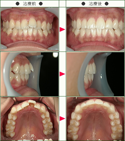 歯のデコボコ矯正症例(Ｉ・Ｍ様　２４歳　女性)