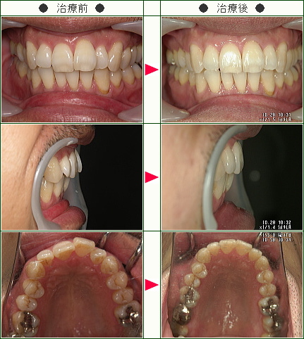 歯のデコボコ症例(Ｉ・Ｍ様　５０歳　男性)