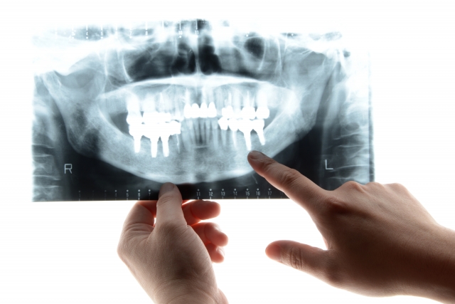 インプラントと歯列矯正両方行うなら安心の矯正認定医へ
