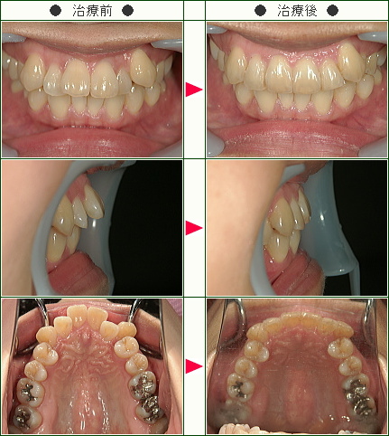 歯のデコボコ矯正症例(いのとも様　４１歳　女性)