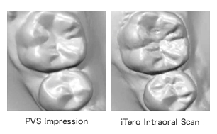 【I-teroのメリット】（シリコン印象との比較）