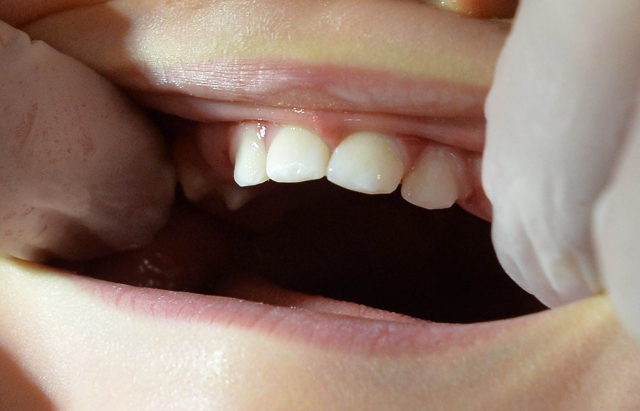 前歯の矯正にかかる治療期間