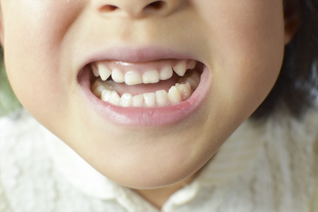 乳歯が癒合歯のケースの対処法