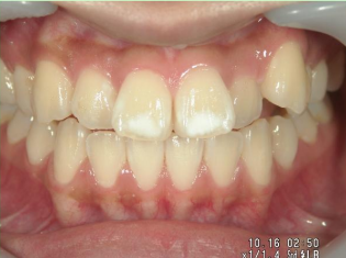 1本だけ引っ込んでいる歯で悩む人は多い