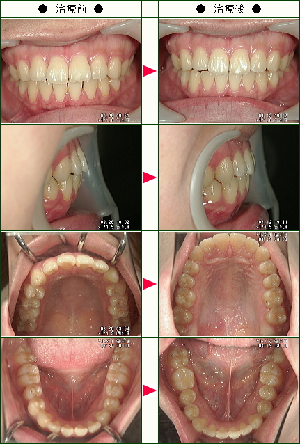 出っ歯矯正症例(石橋様　２２歳　女性)