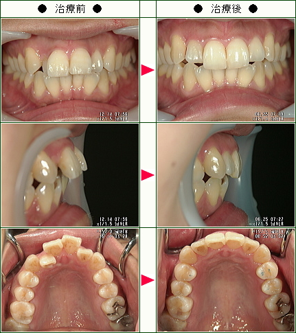 歯のデコボコ矯正症例(いしづか様　２６歳　女性)
