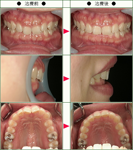 歯のデコボコ矯正症例(石井様　３４歳　女性)