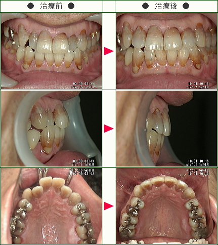 歯のデコボコ矯正症例(石川様　４８歳　男性)