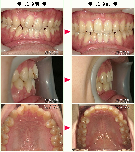 歯のデコボコ矯正症例(伊藤様　２３歳　男性)
