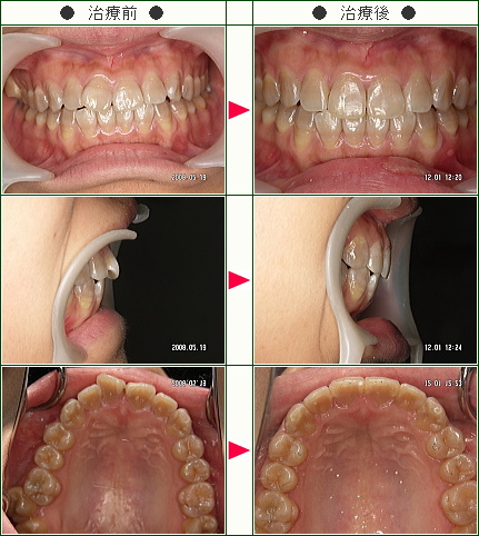 歯のデコボコ矯正症例(伊藤様　２７歳　女性)