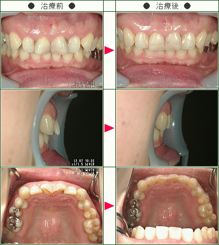 歯のデコボコ矯正症例(じぇじぇじぇ！様　５０歳　女性)