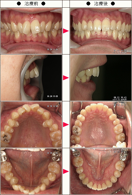 歯のデコボコ矯正症例［仁八様　３０歳　男性］