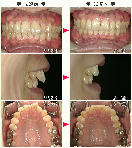 歯のデコボコ矯正症例(ＪＮ様　３５歳　女性)