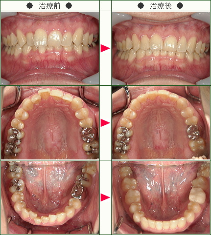 歯のデコボコ矯正症例(Ｊ.Ｏ様　３３歳　女性)