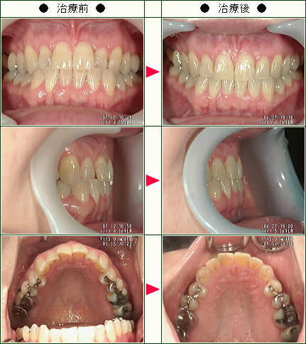 歯のデコボコ矯正症例(Ｊ・Ｓ様　４２歳　女性)