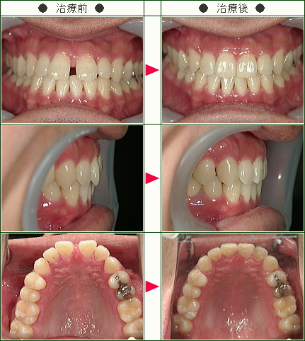 前歯のすきっ歯矯正症例(Ｊ.Ｔ様　３０歳　男性)
