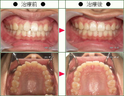 歯のデコボコ矯正症例(Ｋ様　１８歳　女性)