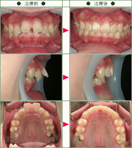 出っ歯矯正症例(Ｋ様　２０歳　女性)