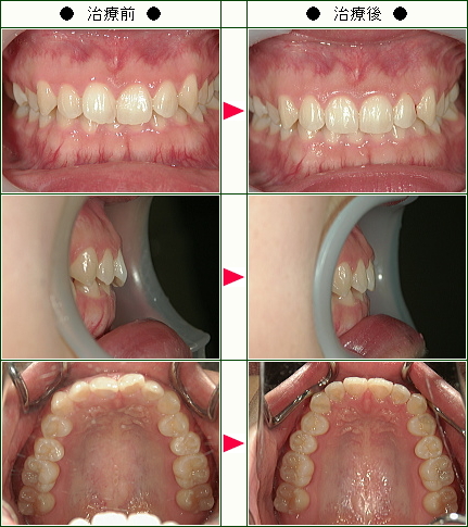 歯のデコボコ矯正症例(Ｋ様　２１歳　女性)