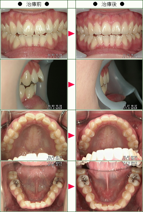 歯のデコボコ矯正症例(Ｋ様　２２歳　女性)