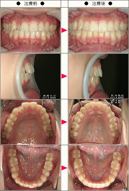 歯のデコボコ矯正症例［Ｋ様　２４歳　女性］