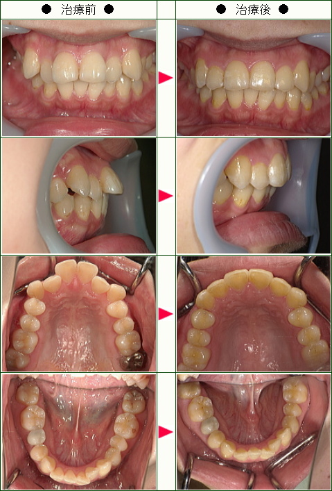 出っ歯矯正症例(Ｋ様　２８歳　女性)