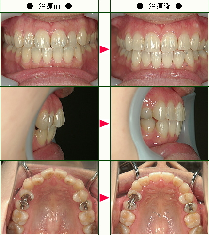 歯のデコボコ矯正症例(Ｋ様　２９歳　女性)