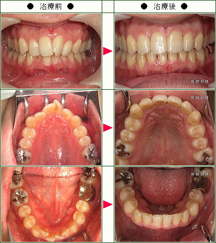 歯のデコボコ矯正症例(Ｋ様　３０歳　男性)