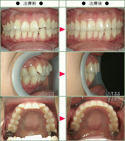 歯のデコボコ矯正症例(Ｋ様　３１歳　女性)