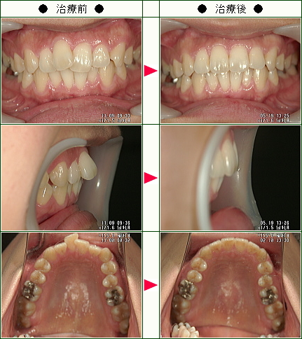 歯のデコボコ矯正症例(Ｋ様　３２歳　女性)