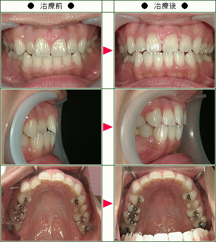 歯のデコボコ矯正症例(Ｋ様　３３歳　女性)