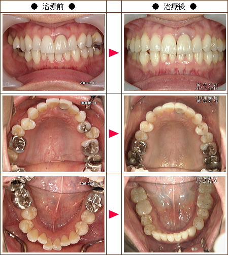 歯のデコボコ矯正症例［Ｋ様　３３歳　女性］