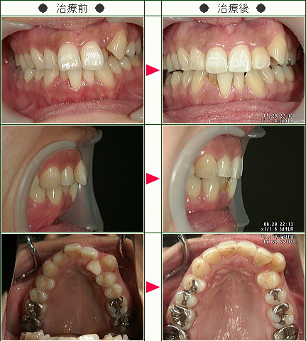 歯のデコボコ矯正症例(Ｋ様　３５歳　女性)