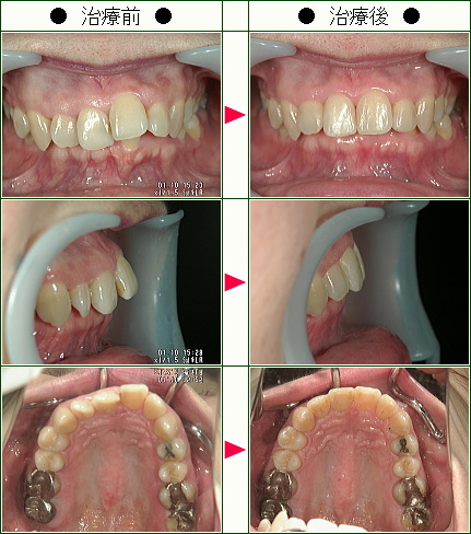 歯のデコボコ矯正症例(Ｋ様　５０歳　女性)