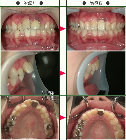 出っ歯矯正症例(Ｋ・Ａ様　２３歳　女性)