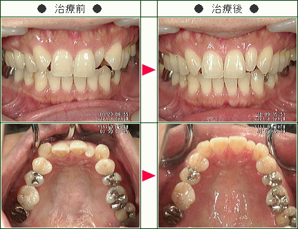 歯のデコボコ矯正症例(甲斐様　３８歳　女性)