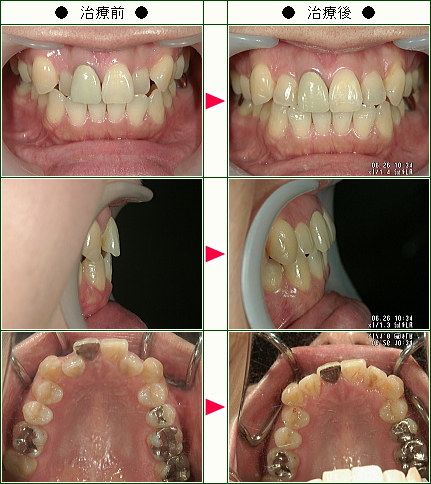 歯のデコボコ矯正症例(釜野様　４５歳　女性)