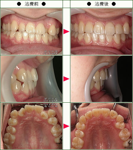 歯のデコボコ矯正症例(上山様　２３歳　女性)