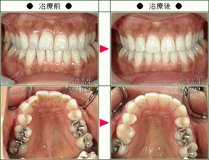歯のデコボコ矯正症例(カナ様　３４歳　女性)