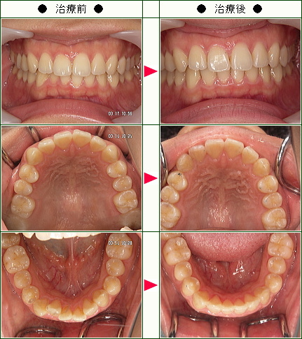 歯のデコボコ矯正症例(かなこ様　２４歳　女性)