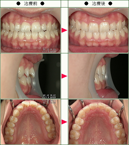 歯のデコボコ矯正症例(金谷様　２３歳　女性)