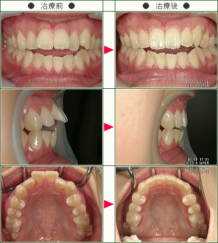 出っ歯矯正症例(金秋様　１８歳　女性)