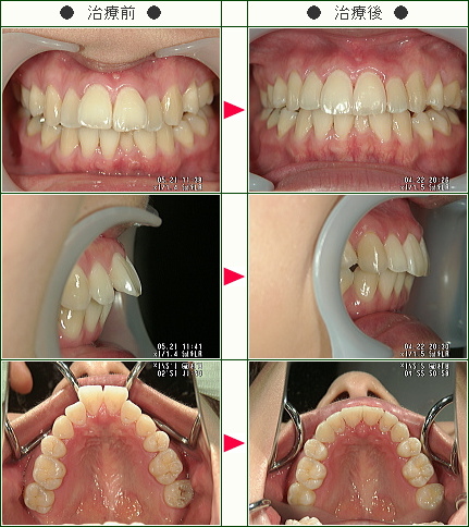 出っ歯矯正症例 上だけの症例 歳から39歳まで 1