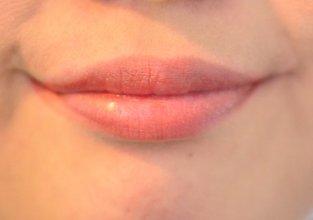 もともと厚い唇は歯列矯正では薄くならない？